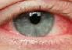 Dấu hiệu nhận biết đau mắt đỏ